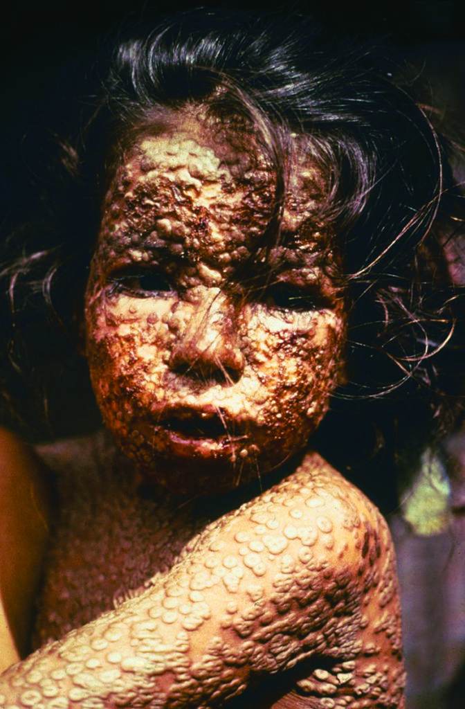 A child with smallpox in Bangladesh in 1973