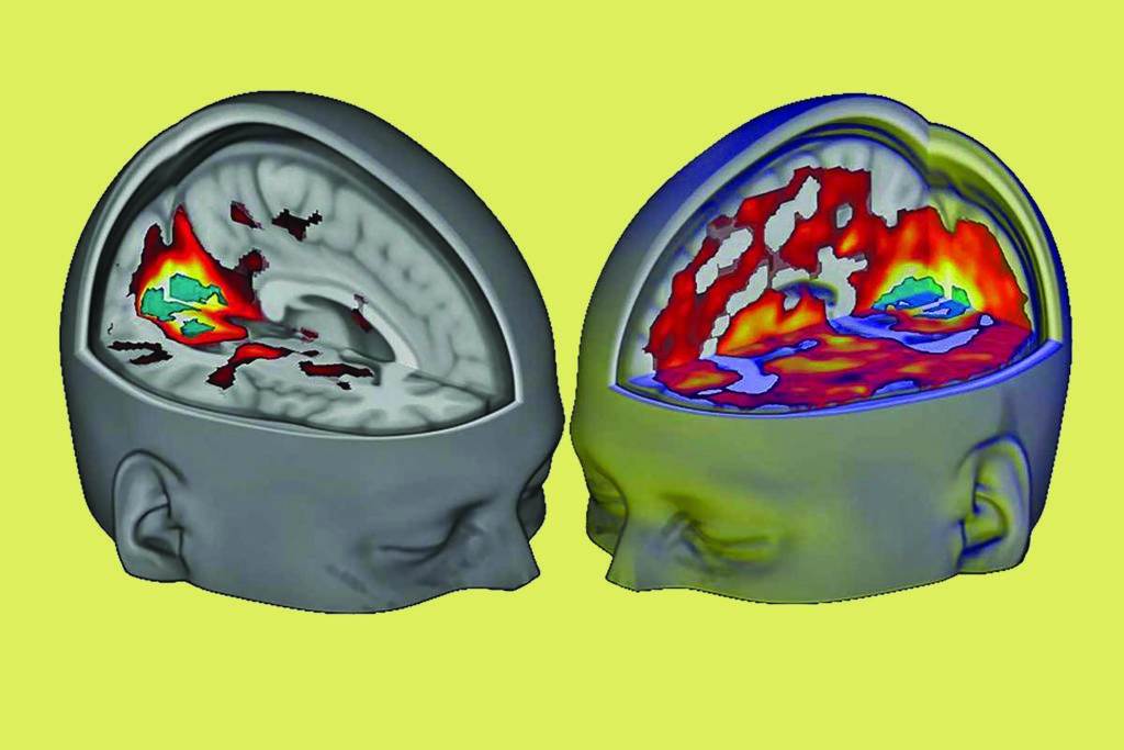 Brain scan images conducted at Imperial College London contrast brain connectivity on placebo (left) and under the influence of LSD (right)